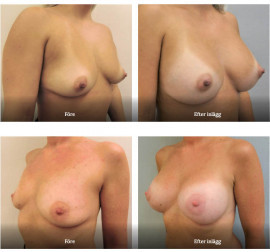 Före och efter bröstkirurgi